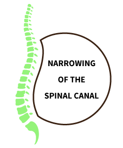 Narrowing of the spinal cord causing sciatica