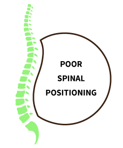 Poor spinal positioning resulting in sciatica